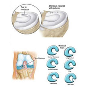 meniscal-repair